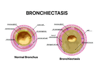 Bronchiectasis. lung disease. Normal bronchus and bronchiectasis.Vector medical illustration. - obrazy, fototapety, plakaty