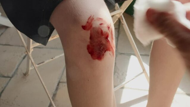 Cleaning a bleeding wound on the knee of a kid with cotton wool and disinfectant liquid. Closeup shot.
