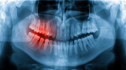 Toothache x-ray radiograph picture showing pain in tooth nerve - obrazy, fototapety, plakaty