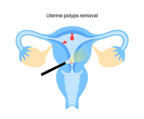 uterine polyp endometrial