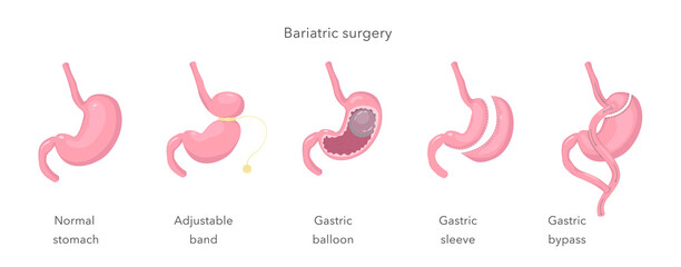Methods of weight loss operation. Bariatric surgery. Human anatomy illustration for infographics, atlas, textbook or study material.