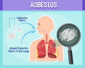 Fototapeta premium Diagram showing asbestosis in lungs