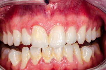 close up view of massive plaque and inflammation