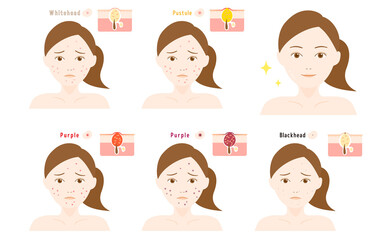 にきびの女性の顔と皮膚断面図
