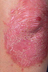 Unrecognizable man feel bad on skin disease called psoriasis. Large red, inflamed, rash on elbows