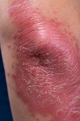 Unrecognizable man feel bad on skin disease called psoriasis. Large red, inflamed, rash on elbows
