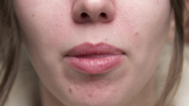 Close-up of a caucasian woman. Chin and mouth. The girl yawns. Correction of bite in young people with acne on the chin