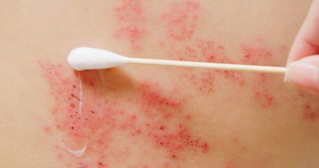 man with shingles disease