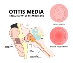 Acute Otitis Media air filled space eardrum treat pain fluid tube pus bacteria virus nasal cold flu drain swollen mastoid prevent diagnostic exam canal tool ENT Nose otalgia vertigo BPPV head wax test