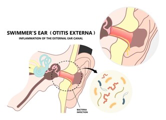 acute otitis of the inner with Swimmer's ear canal wax swelling