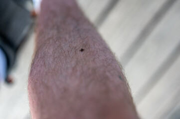 A single male dog tick crawling up leg hair on a Caucasian male. 