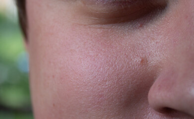 Fototapeta premium Skin texture with enlarged pores and red rashes. Environmental impact on sensitive skin concept.