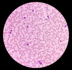Thrombocythemia with leukocytosis, Essential thrombocytosis blood smear, present high platelets and leukocytes, microscope view.