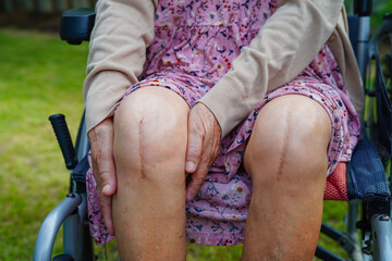 Asian elderly woman patient with scar knee replacement surgery in hospital.