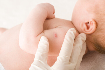 Doctor hand in white rubber protective glove showing red point after tuberculosis vaccine on...