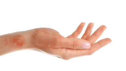 Woman showing hand with dry skin on white background, closeup