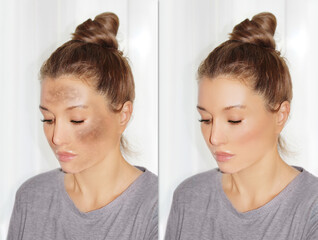 Dark spots, freckles,hyperpigmentation(melasma or chloasma),concept - skin lightening, skin...