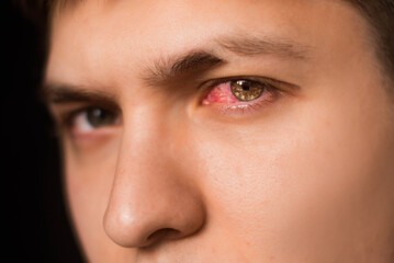 Close up of one annoyed red blood eye of male affected by conjunctivitis or after flu, cold or...