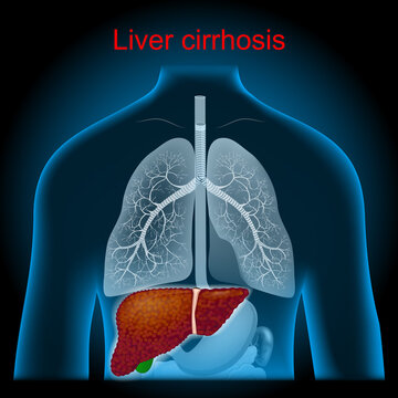 Cirrhosis. liver have damage