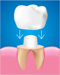 Dental Crown Restoration, Dental care concept, Realistic design illustration Vector. 