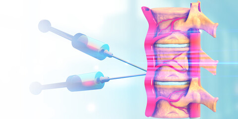 Spinal injection concept. 3d illustration. - obrazy, fototapety, plakaty
