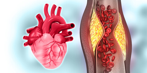 Cholesterol blocked arteries with human heart. 3d illustration.