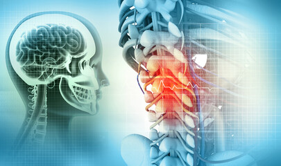 Spine cancer or spinal disease, 3d illustration