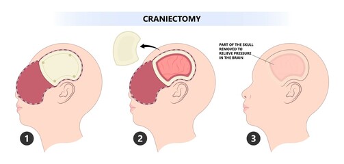surgical to repair the skull bone with the metal mesh the procedure in medical