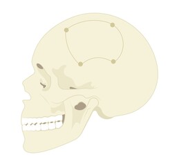 surgical to repair the skull bone with the metal mesh the procedure in medical