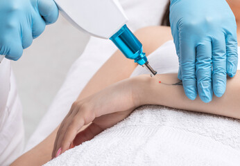 The doctor makes the procedure for laser tattoo removal on the girl's arm.