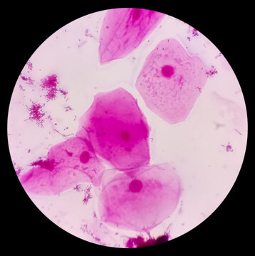 Prostatic Smear (PS) gram stain microscopic 40x show epithelial cells. Large number of gram positive Diplococci and few gram negative rods shape bacteria.