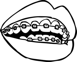 Braces on the teeth. Medical dentist checkup in dental clinic. Tooth correction with brackets. Open mouth showing healthy teeth and gums. Hand drawn vintage vector illustration. Old style drawing.