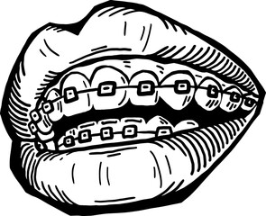 Braces on the teeth. Medical dentist checkup in dental clinic. Tooth correction with brackets. Open mouth showing healthy teeth and gums. Hand drawn vintage vector illustration. Old style drawing.