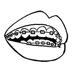 Braces on the teeth. Medical dentist checkup in dental clinic. Tooth correction with brackets. Open mouth showing healthy teeth and gums. Hand drawn retro vintage illustration. Old style drawing.