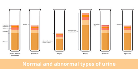 Normal сhemical сomposition of urine and its abnormal types. Common types of abnormal urine include proteinuria, oliguria, hematuria, and glycosuria.