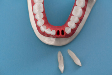 Teeth implant and crown installation process parts isolated on a blue background. Medically accurate 3D model. 