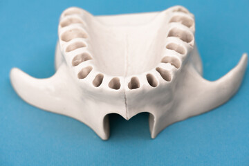 Upper human jaw without teeth model medical implant isolated on blue background. Healthy teeth, dental care and orthodontic concept.