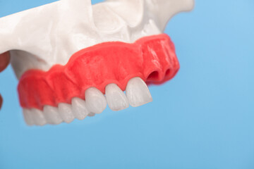 Teeth implant and crown installation process parts isolated on a blue background. Medically accurate 3D model. 
