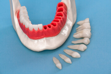Teeth implant and crown installation process parts isolated on a blue background. Medically accurate 3D model. 