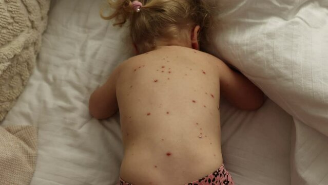 Little toddler girl with chickenpox in bed, playing at home, quarantine isolation during sickness, Varicella zoster virus or Chickenpox bubble rash