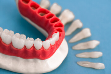 Teeth implant and crown installation process parts isolated on a blue background. Medically accurate 3D model. 