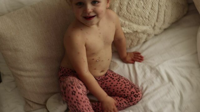 Little toddler girl with chickenpox in bed, playing at home, quarantine isolation during sickness, Varicella zoster virus or Chickenpox bubble rash
