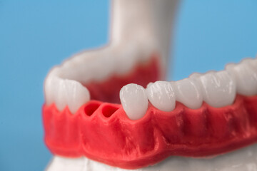 Teeth implant and crown installation process parts isolated on a blue background. Medically...