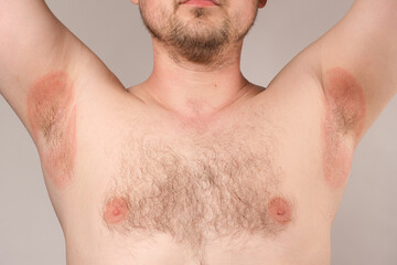 Fototapeta premium Redness of the armpits in a man - inflammation or prickly heat, red spots of the armpits.