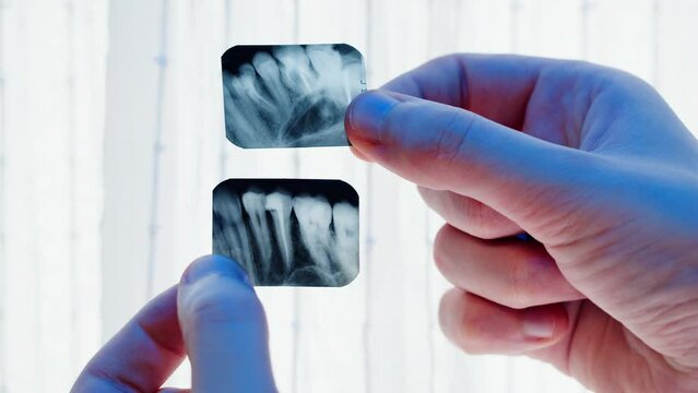Teeth x-ray close-up. Doctor examining xray of tooth, Magnetic Resonance Imaging. Healthcare and medicine, dentistry, stomatology concept.