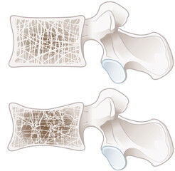 Osteoporosis, normal vertebra and osteoporotic vertebra. Labeled illustration