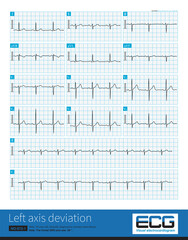 Male, 50 years old, suffering from coronary heart disease. The frontal QRS axis was -39 °, which was not enough to diagnose left anterior fascicular block.Lead II QRS main wave is negative.