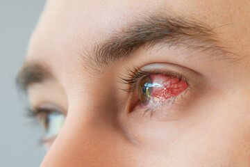 Close up of male brown bloodshot eyes and redness with vessels. Concept of keratitis, inflammation...
