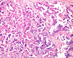 Ovarian mucinous cystadenocarcinoma