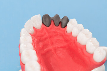 Teeth implant and crown installation process parts isolated on a blue background. Medically accurate 3D model. 
